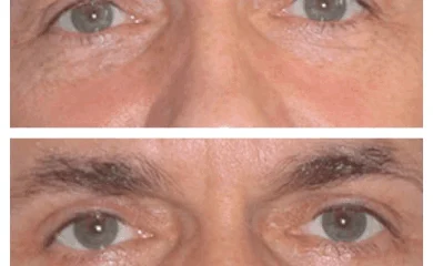 Eye Bag Removal Surgery