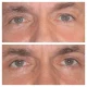 Eye Bag Removal Surgery