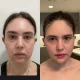 Buccal Fat Removal